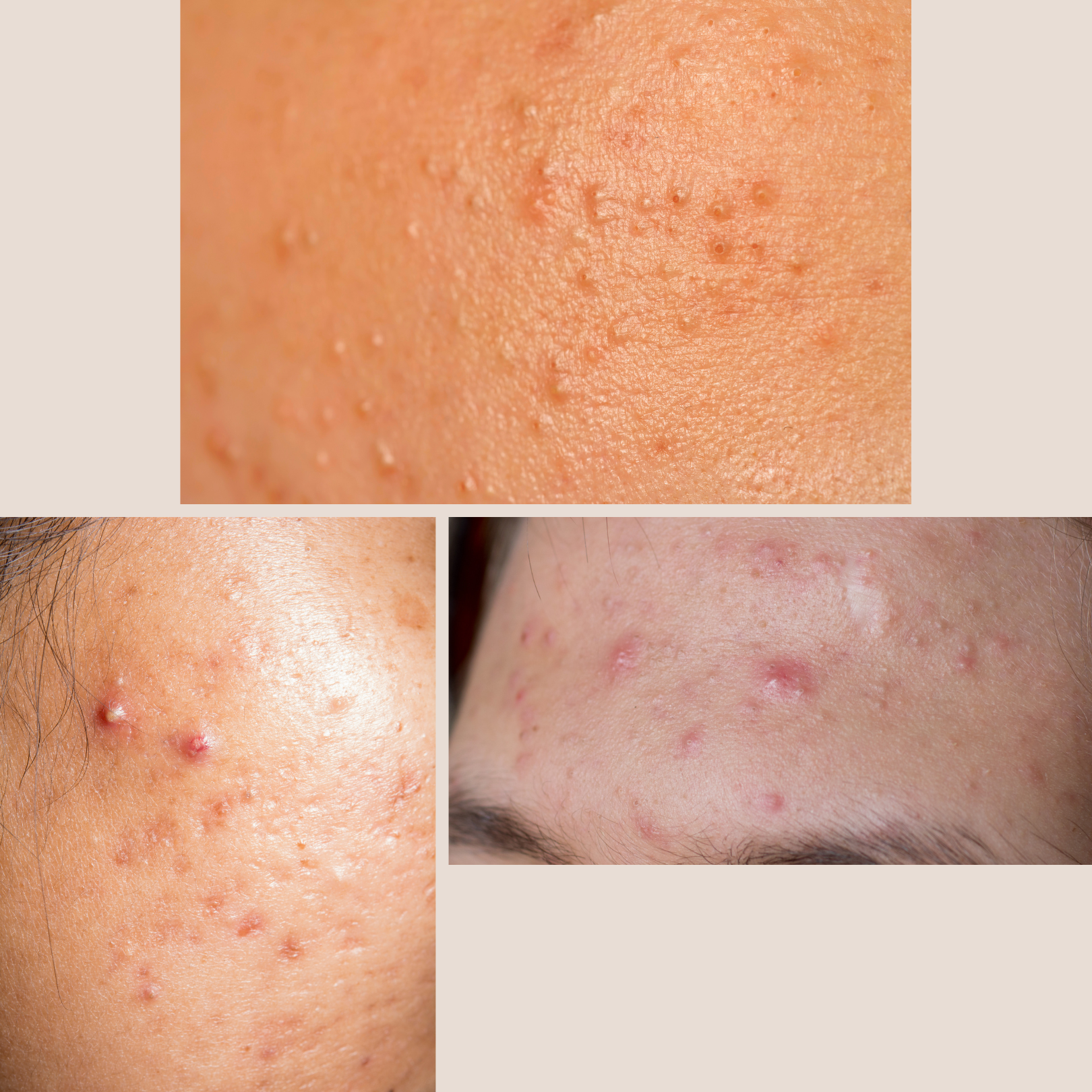 malassezia gombás akné