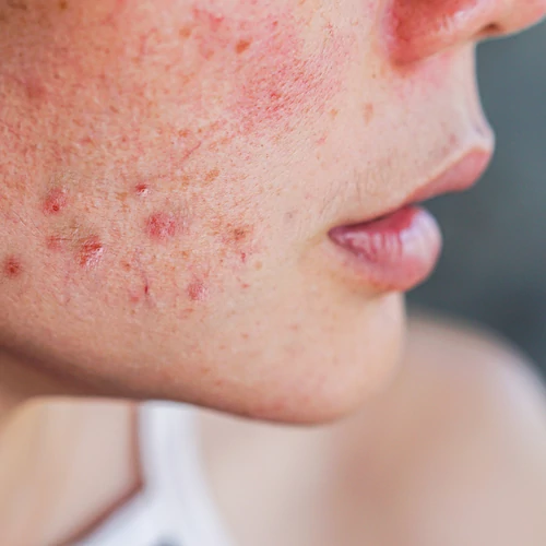 Malassezia okozta gombás akné és seborrheás dermatitis: hogyan ismerd fel?